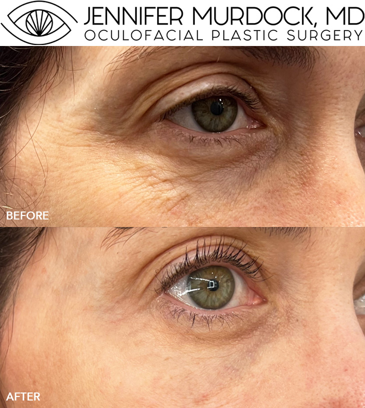 Tear Trough Filler and Neuromodulator Injections for Crow’s-Feet Tear Trough Filler and Neuromodulator Injections for Crow’s-Feet