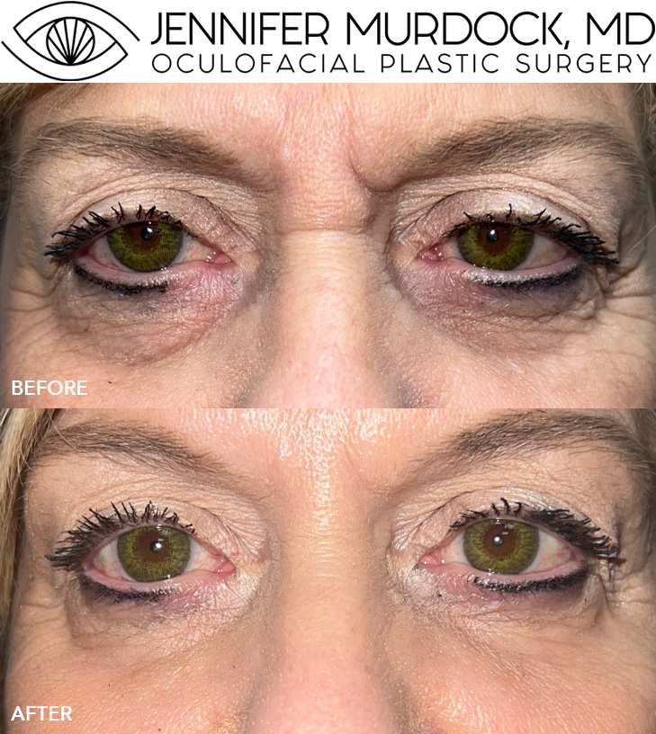Under Eye Filler Under Eye Filler
