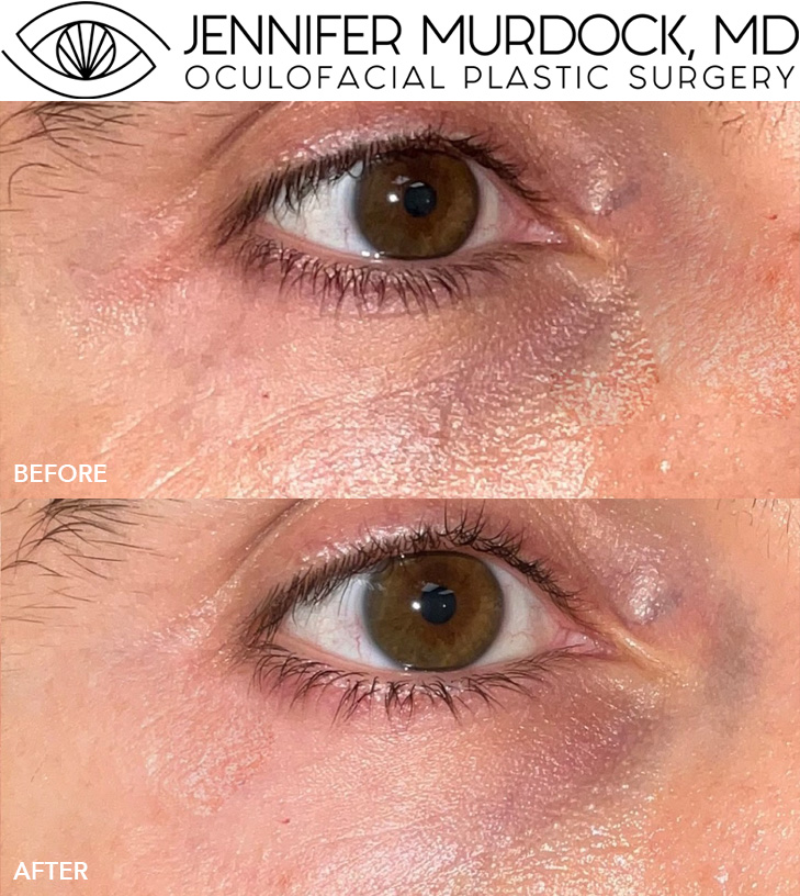 Cosmetic Injections Patient 11 Cosmetic Injections Patient 11