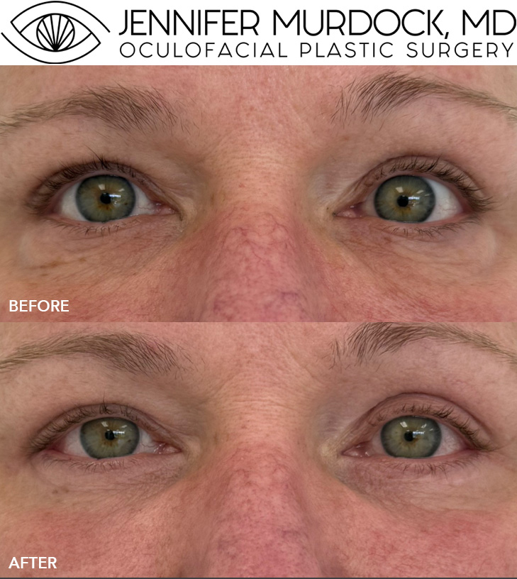 Lower Blepharoplasty Patient 1