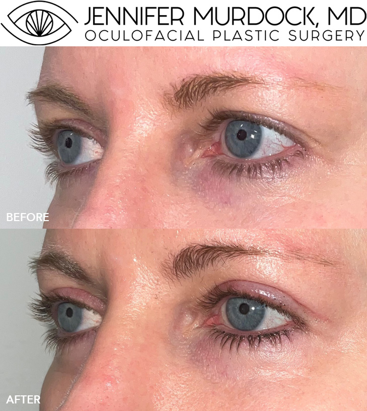 Baby Blepharoplasty Patient 1