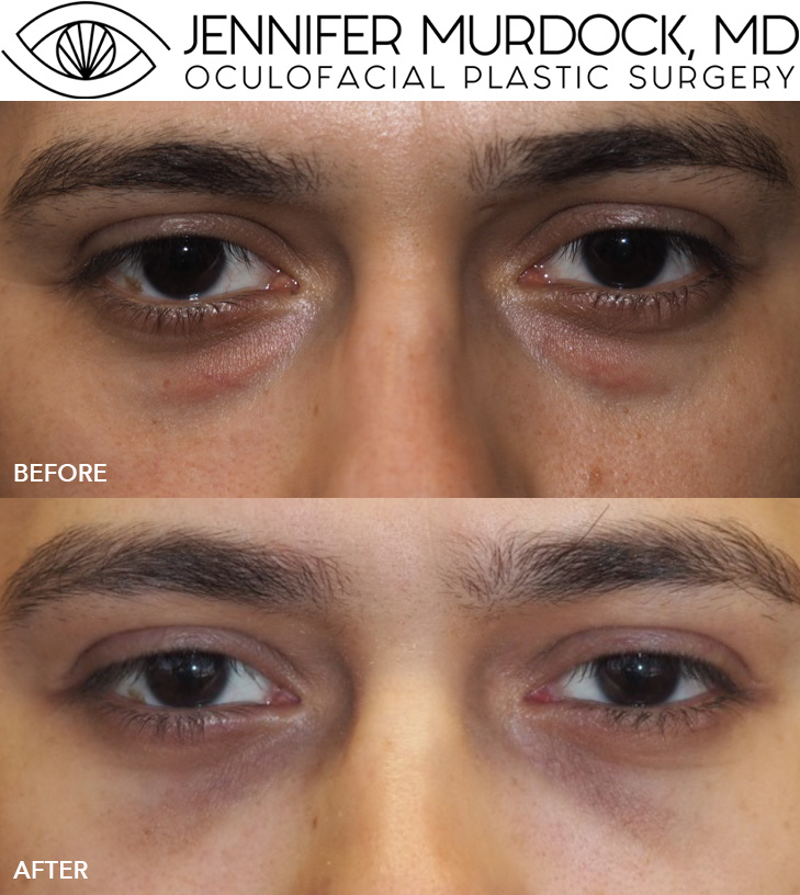 Lower Blepharoplasty Patient 2