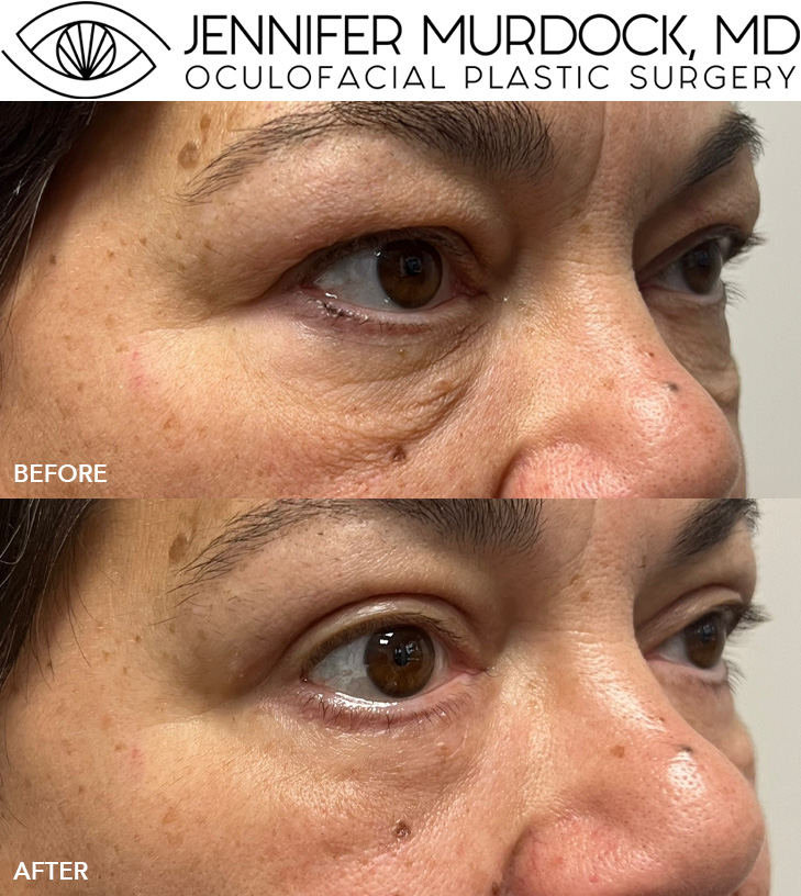 Quad Blepharoplasty Patient 2 Quad Blepharoplasty Patient 2