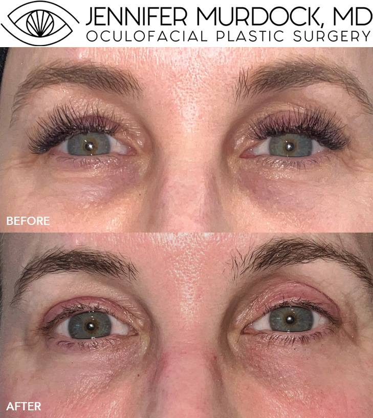 Baby Blepharoplasty Patient 2