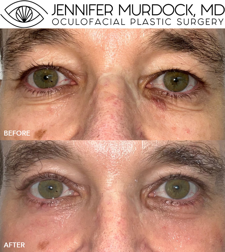 Quad Blepharoplasty with Laser Resurfacing Quad Blepharoplasty with Laser Resurfacing