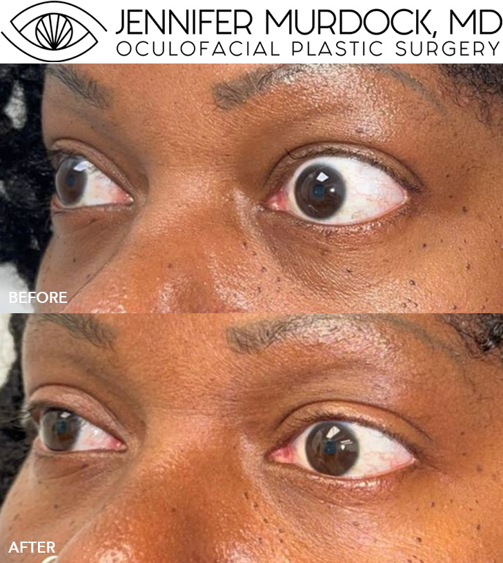 Tepezza Treatment for Thyroid Eye Disease Tepezza Treatment for Thyroid Eye Disease