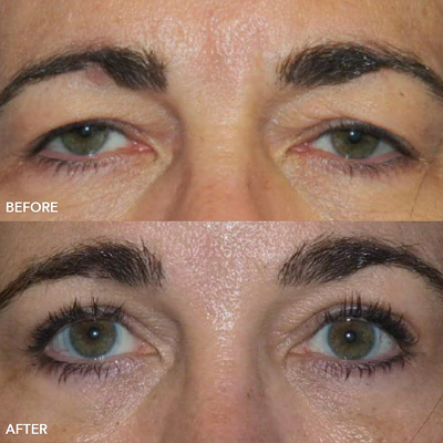Brow Surgery Image
