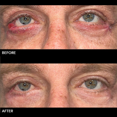 Corrective Eyelid Surgery Image