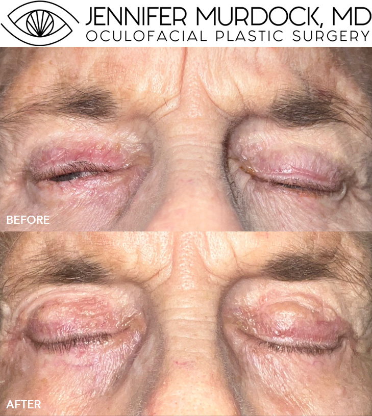 Corrective Surgery with Skin Graft