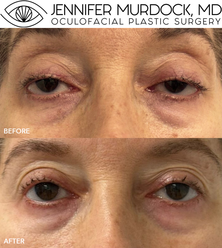 External Ptosis Repair