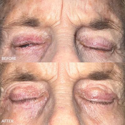 Eyelid Reconstruction Image