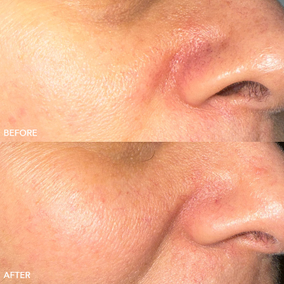 Laser Treatments Image