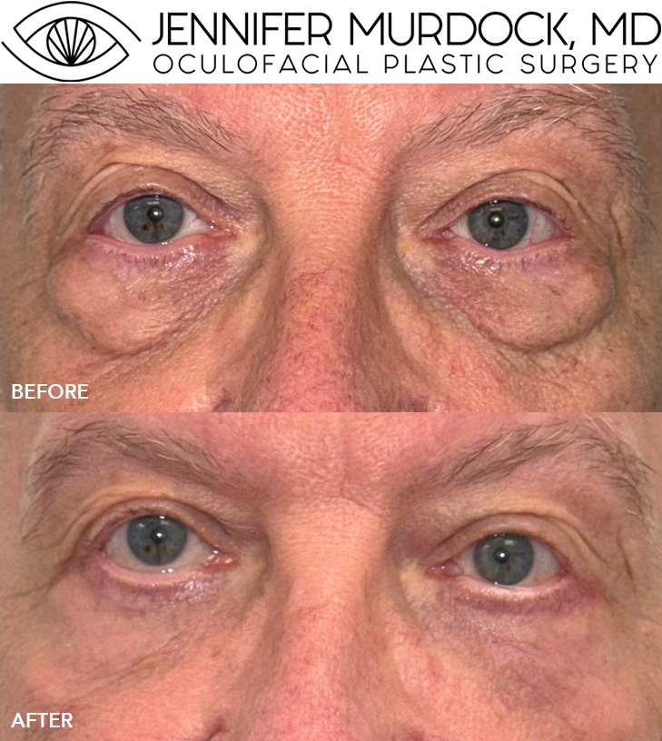 Lower Eyelid Blepharoplasty with Periocular Laser Resurfacing