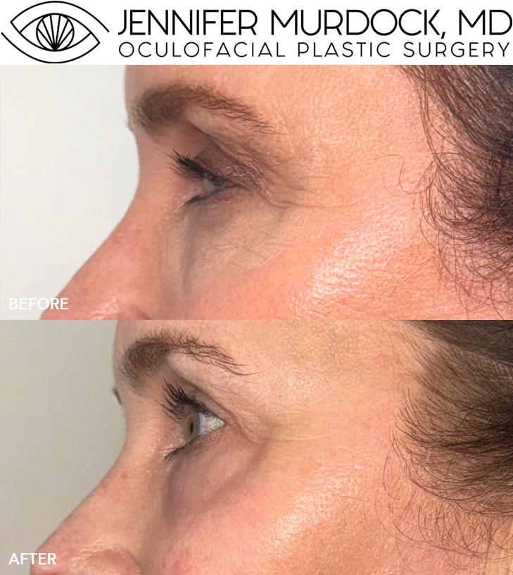 Periocular UltraClear Laser Resurfacing
