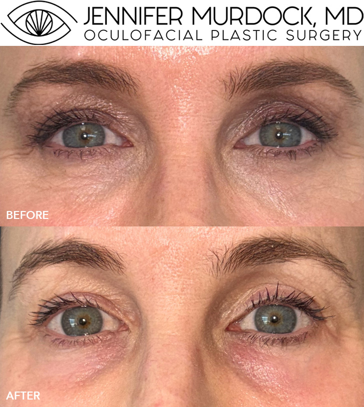 Periocular UltraClear Laser Resurfacing