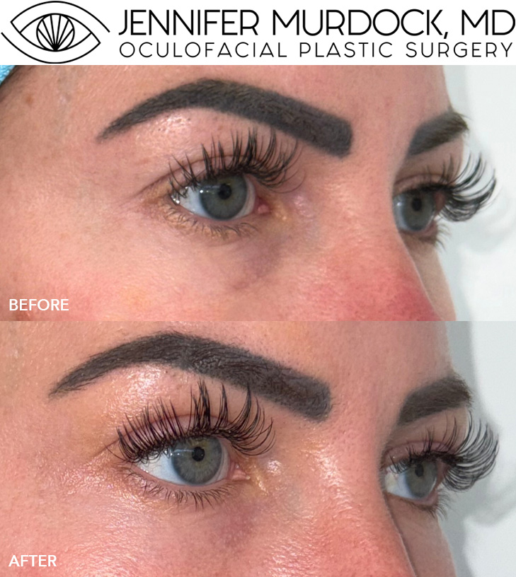 Periocular Laser Resurfacing and Laser Coring