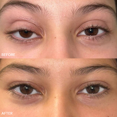 Ptosis Repair Image