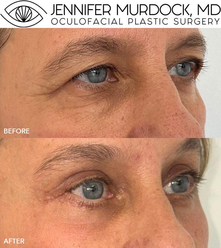 Quad Blepharoplasty, Endoscopic Brow Lift, UltraClear Laser Resurfacing