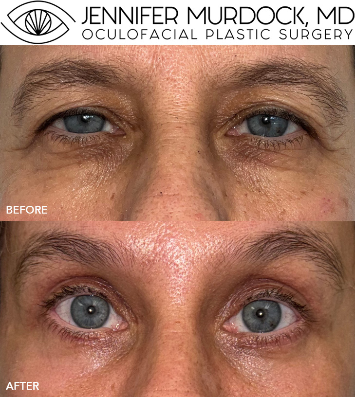 Quad Blepharoplasty, Endoscopic Brow Lift, UltraClear Laser Resurfacing