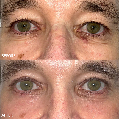 Quad Blepharoplasty Image