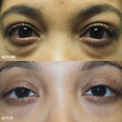 Thyroid Eye Disease Image