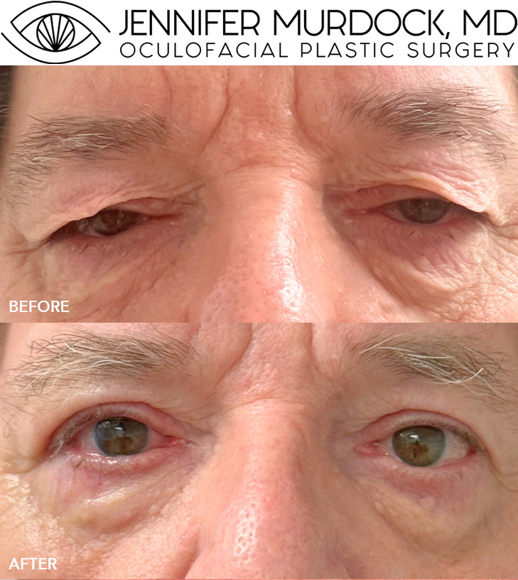 Upper Eyelid Blepharoplasty, Direct Temporal Brow Lift, Lower Eyelid Ectropion Repair