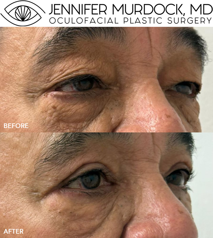 Upper Eyelid Blepharoplasty and Lateral Canthoplasty