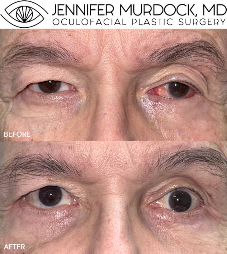 Left Lower Eyelid Entropion and BUL Bleph (angled view)