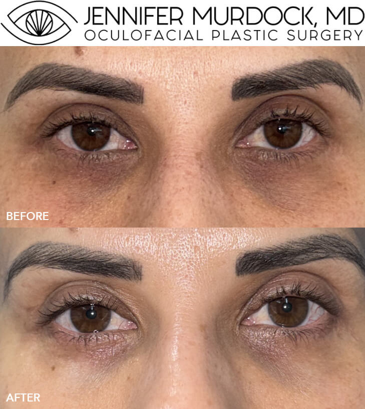Laser for Dark Circles